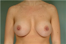 Breast Augmentation After Photo by Robert Zubowski, MD; Paramus, NJ - Case 33397