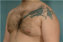 Male Breast Reduction After Photo by Robert Zubowski, MD; Paramus, NJ - Case 33402