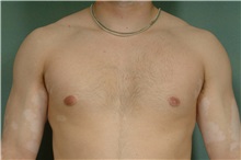 Male Breast Reduction After Photo by Robert Zubowski, MD; Paramus, NJ - Case 33403