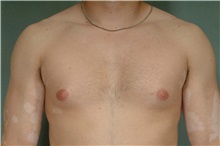 Male Breast Reduction Before Photo by Robert Zubowski, MD; Paramus, NJ - Case 33403