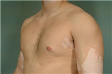 Male Breast Reduction After Photo by Robert Zubowski, MD; Paramus, NJ - Case 33403