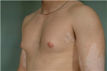 Male Breast Reduction Before Photo by Robert Zubowski, MD; Paramus, NJ - Case 33403