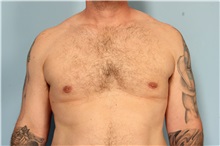 Male Breast Reduction After Photo by Robert Zubowski, MD; Paramus, NJ - Case 33404