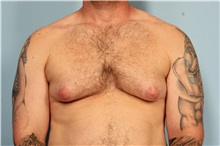 Male Breast Reduction Before Photo by Robert Zubowski, MD; Paramus, NJ - Case 33404
