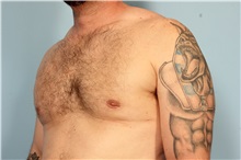 Male Breast Reduction After Photo by Robert Zubowski, MD; Paramus, NJ - Case 33404