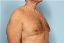 Male Breast Reduction After Photo by Robert Zubowski, MD; Paramus, NJ - Case 33405
