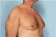 Male Breast Reduction Before Photo by Robert Zubowski, MD; Paramus, NJ - Case 33405