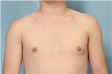 Male Breast Reduction After Photo by Robert Zubowski, MD; Paramus, NJ - Case 33406