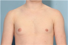 Male Breast Reduction Before Photo by Robert Zubowski, MD; Paramus, NJ - Case 33406