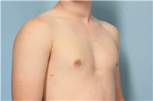 Male Breast Reduction After Photo by Robert Zubowski, MD; Paramus, NJ - Case 33406