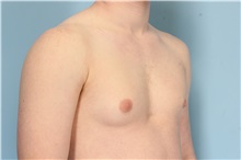 Male Breast Reduction Before Photo by Robert Zubowski, MD; Paramus, NJ - Case 33406