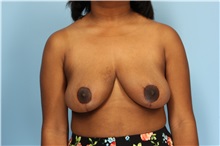 Breast Reduction After Photo by Robert Zubowski, MD; Paramus, NJ - Case 33428