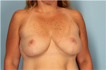 Breast Reduction After Photo by Robert Zubowski, MD; Paramus, NJ - Case 33440