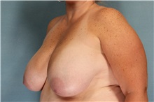 Breast Reduction Before Photo by Robert Zubowski, MD; Paramus, NJ - Case 33440