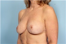 Breast Reduction After Photo by Robert Zubowski, MD; Paramus, NJ - Case 33441