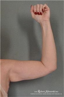 Arm Lift After Photo by Robert Zubowski, MD; Paramus, NJ - Case 34356