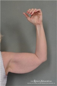 Arm Lift Before Photo by Robert Zubowski, MD; Paramus, NJ - Case 34356