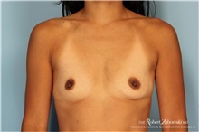 Breast Augmentation Before Photo by Robert Zubowski, MD; Paramus, NJ - Case 34358