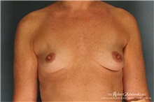 Breast Augmentation Before Photo by Robert Zubowski, MD; Paramus, NJ - Case 34375