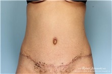Liposuction After Photo by Robert Zubowski, MD; Paramus, NJ - Case 34377