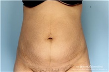 Liposuction Before Photo by Robert Zubowski, MD; Paramus, NJ - Case 34377