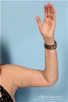 Arm Lift After Photo by Robert Zubowski, MD; Paramus, NJ - Case 34378
