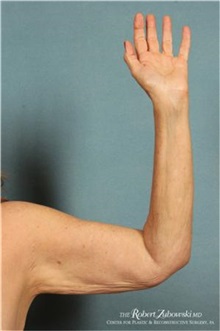 Arm Lift Before Photo by Robert Zubowski, MD; Paramus, NJ - Case 34378