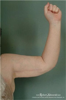 Arm Lift After Photo by Robert Zubowski, MD; Paramus, NJ - Case 34379