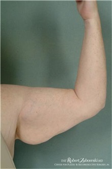 Arm Lift Before Photo by Robert Zubowski, MD; Paramus, NJ - Case 34379