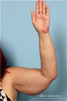 Arm Lift Before Photo by Robert Zubowski, MD; Paramus, NJ - Case 34380