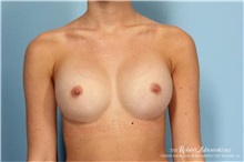 Breast Augmentation After Photo by Robert Zubowski, MD; Paramus, NJ - Case 34394