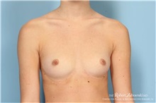 Breast Augmentation Before Photo by Robert Zubowski, MD; Paramus, NJ - Case 34394