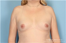 Breast Augmentation Before Photo by Robert Zubowski, MD; Paramus, NJ - Case 34396