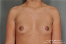 Breast Augmentation Before Photo by Robert Zubowski, MD; Paramus, NJ - Case 34398