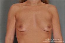 Breast Augmentation Before Photo by Robert Zubowski, MD; Paramus, NJ - Case 34399