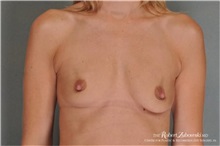 Breast Augmentation Before Photo by Robert Zubowski, MD; Paramus, NJ - Case 34400