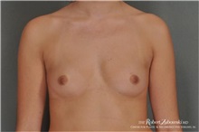 Breast Augmentation Before Photo by Robert Zubowski, MD; Paramus, NJ - Case 34401