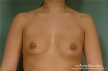 Breast Augmentation Before Photo by Robert Zubowski, MD; Paramus, NJ - Case 34403