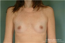 Breast Augmentation Before Photo by Robert Zubowski, MD; Paramus, NJ - Case 34407
