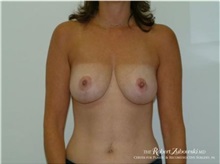 Breast Reduction After Photo by Robert Zubowski, MD; Paramus, NJ - Case 34421