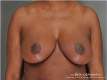 Breast Reduction After Photo by Robert Zubowski, MD; Paramus, NJ - Case 34430