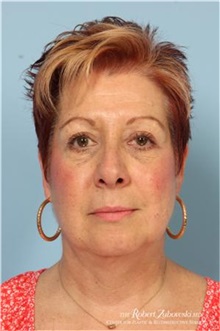 Eyelid Surgery After Photo by Robert Zubowski, MD; Paramus, NJ - Case 34453