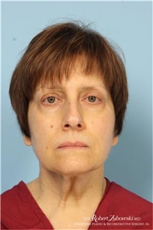 Eyelid Surgery Before Photo by Robert Zubowski, MD; Paramus, NJ - Case 34454