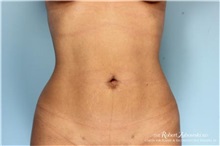 Liposuction After Photo by Robert Zubowski, MD; Paramus, NJ - Case 34482