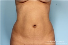 Liposuction Before Photo by Robert Zubowski, MD; Paramus, NJ - Case 34482