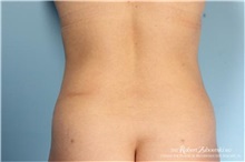 Liposuction After Photo by Robert Zubowski, MD; Paramus, NJ - Case 34483