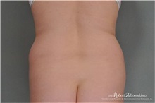 Liposuction Before Photo by Robert Zubowski, MD; Paramus, NJ - Case 34483