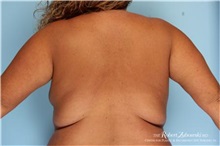 Liposuction Before Photo by Robert Zubowski, MD; Paramus, NJ - Case 34484