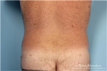 Liposuction After Photo by Robert Zubowski, MD; Paramus, NJ - Case 34485