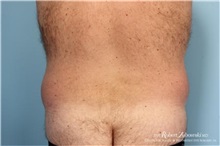 Liposuction Before Photo by Robert Zubowski, MD; Paramus, NJ - Case 34485